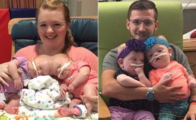 Conjoined Twins Who Survived A Rare Surgery Preparing To Go Home